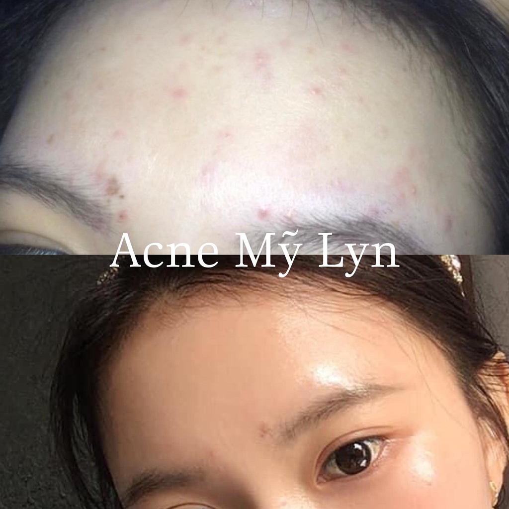 ACNE CHẤM MỤN MỸ LYN CHÍNH HÃNG 10 TẶNG 1 KÈM TÚI PHIẾU