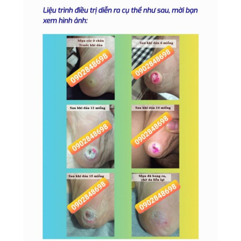Miếng dán mụn cóc