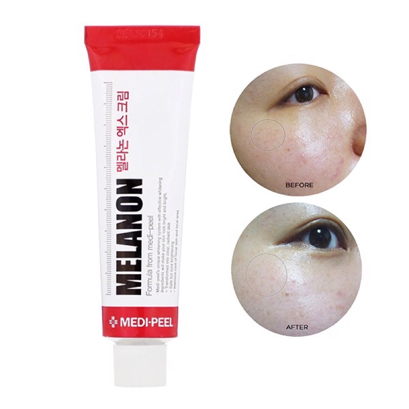 Kem Dưỡng Phục Hồi Chuyên Sâu Cho Da Mụn Medi-Peel 30ml