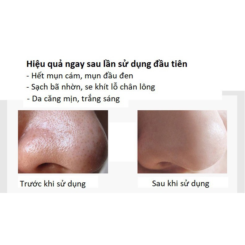 Miếng Gel lột mụn than tre hoạt tính - lột mụn cám - mụn đầu đen 6gr | Thế Giới Skin Care