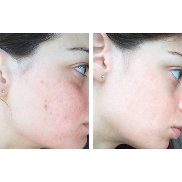 The Ordinary Serum Tinh Chất Giảm Thâm Mụn The Ordinary Niacinamide 10% + Zinc 1%
