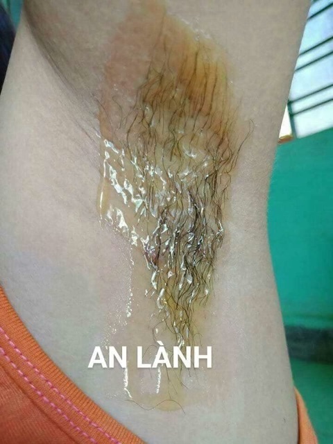 Triệt lông an lành