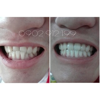 Dụng cụ niềng răng