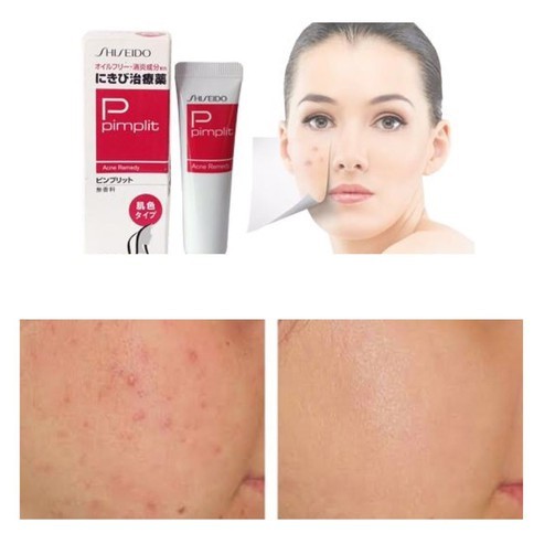 Kem mụn shiseido pimplit Nhật Bản