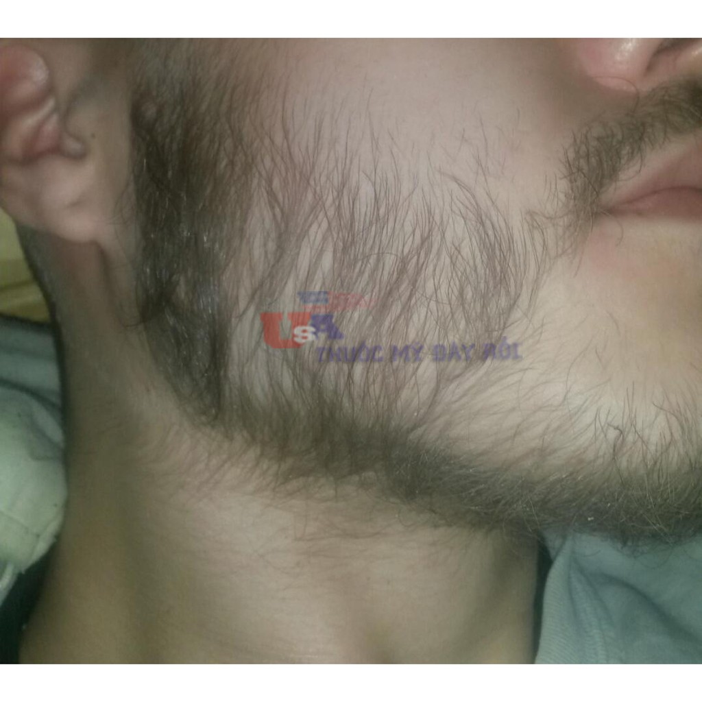 Thuốc Kích Mọc Râu Tóc Minoxidil Morr 12.5% Dạng Lỏng, Minoxidil 12.5% Hàm Lượng Cao