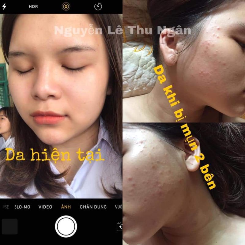 Serum đánh bay mụn 11day Linh Hương | BigBuy360 - bigbuy360.vn