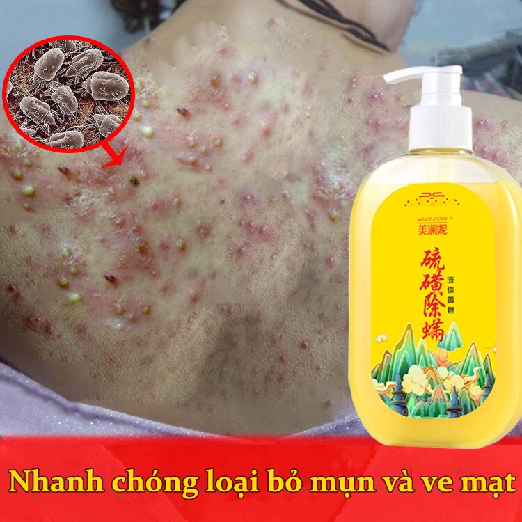 sữa tắm chống mụn 260ml sữa tắm dưỡng trắng giúp giải quyết vấn đề da khô ráp ngứa kháng khuẩn loại loại bỏ mùi mùi hôi