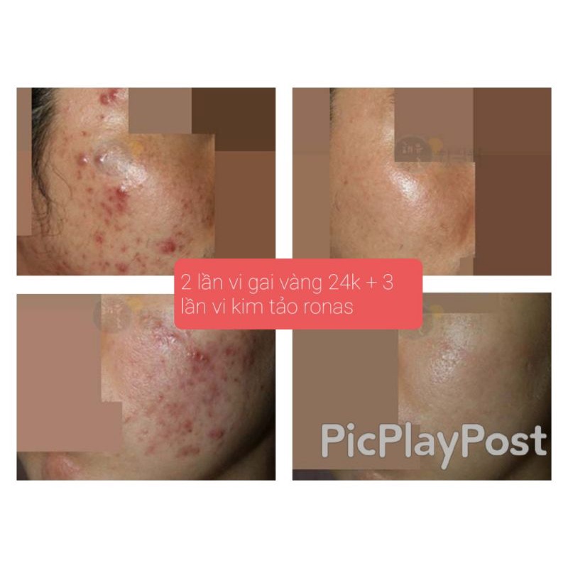 Tinh chất phục hồi te bao goc laksmira