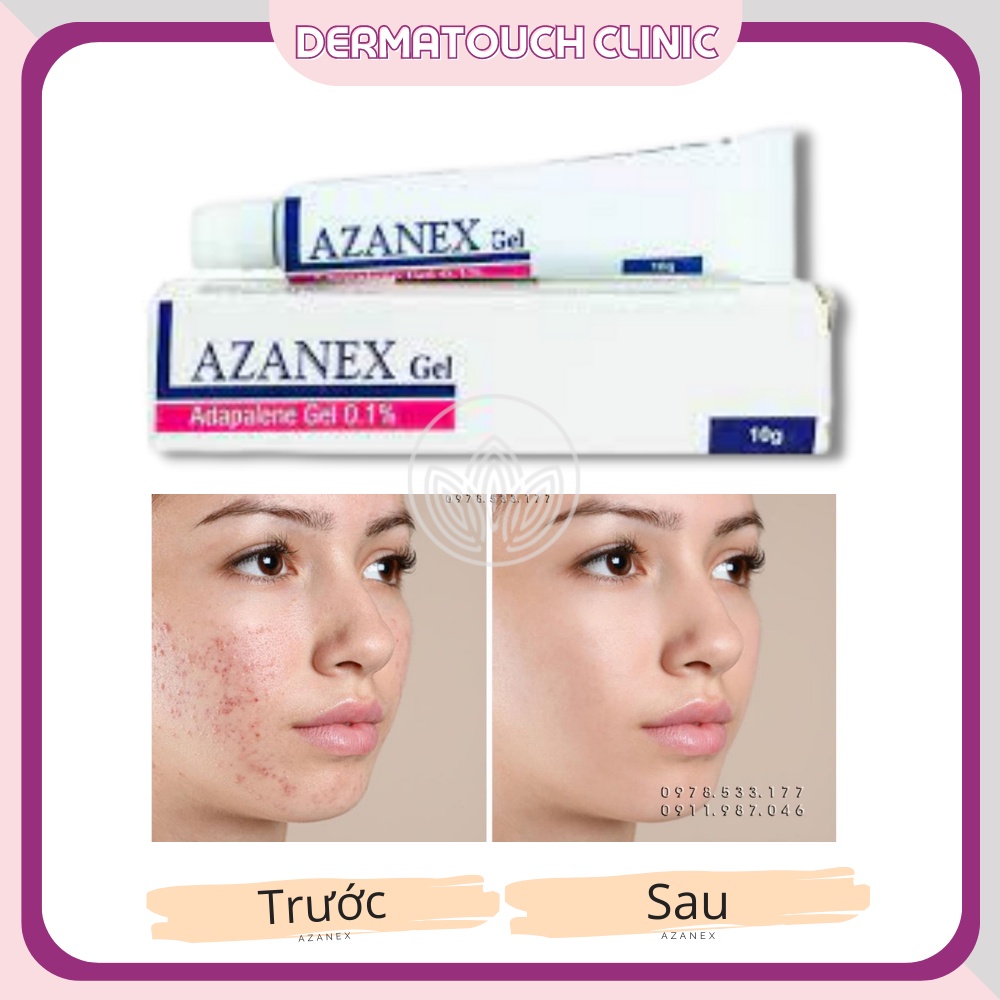 Gel chấm mụn Azanex, chăm sóc da mụn ẩn 10g GIBE COSMETICS