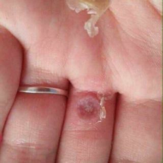 Chấm mụn cốc Cynep của NGA 3ml