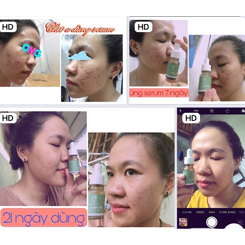 Serum Diếp Cá GIẢM MỤN, THÂM, SE KHÍT LỖ CHÂN LÔNG. | BigBuy360 - bigbuy360.vn