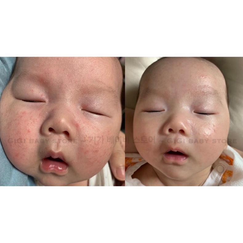 [ Chính Hãng] KEM DƯỠNG MẶT DA KHÔ NẺ CHÀM ATOPALM FACE CREAM TRẺ SƠ SINH,TRẺ EM,NGƯỜI LỚN &lt;35ml&gt;
