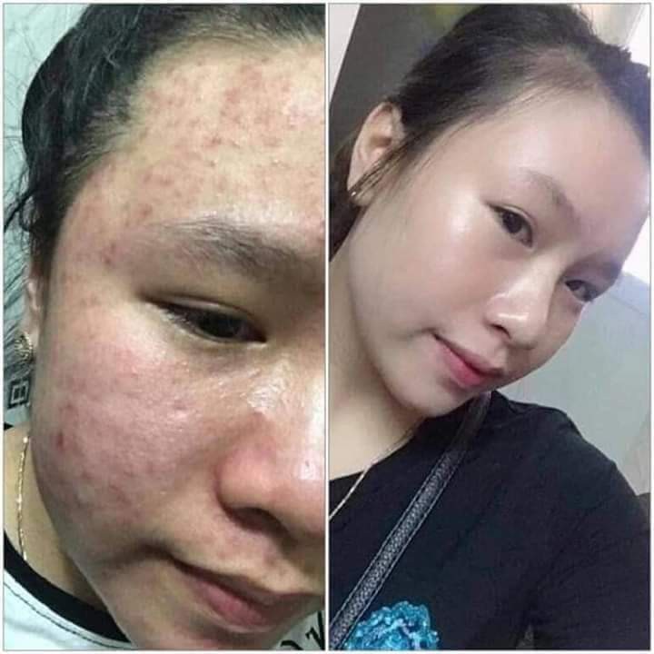 Kem mụn Hoa Đào Đông Y- chuyên sỉ giá gốc | BigBuy360 - bigbuy360.vn