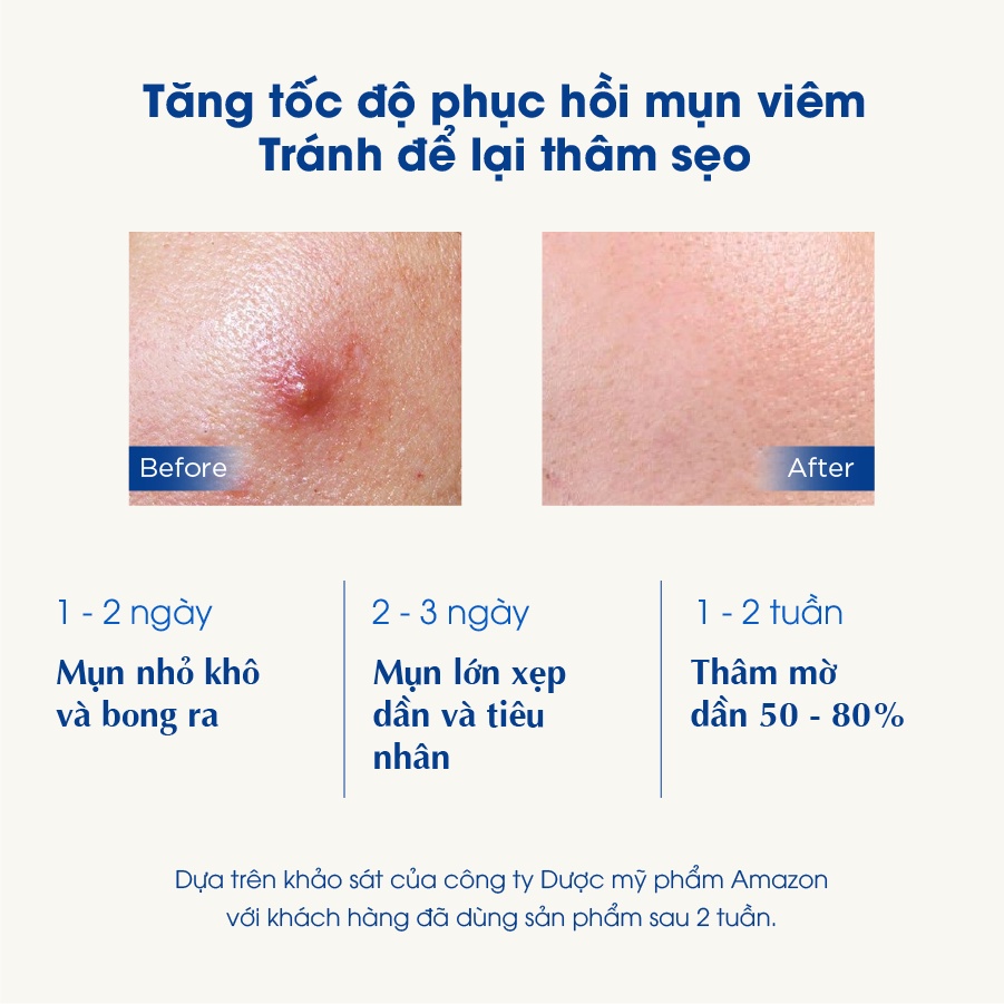 Combo 5 Kem Ngừa Mụn Sahemul Dùng Cho Mụn Viêm, Mụn Bọc, Mụn Mủ, Mụn Trứng Cá Và Thâm Mụn 20gr