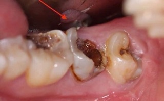 Thảo dược về răng miệng Lợi An