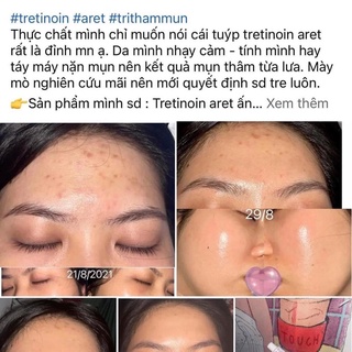 𝐓𝐑𝐄𝐓𝐈𝐍𝐎𝐈𝐍 𝐆𝐞𝐥 𝐀𝐑𝐄𝐓 𝐔𝐒𝐏 𝐌𝐄𝐍𝐀𝐑𝐈𝐍𝐈 𝐀̂́𝐍 Đ𝐎̣̂