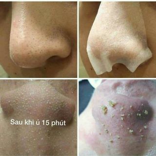 Ủ Mụn Cám Mụn Đầu Đen