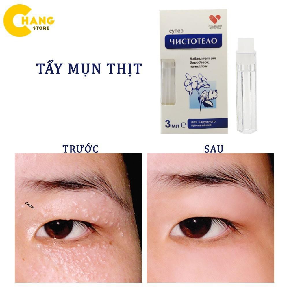 Thuốc tẩy nốt ruồi 💕FREESHIP💕 Thuốc xóa ruồi an toàn tại nhà của Nga