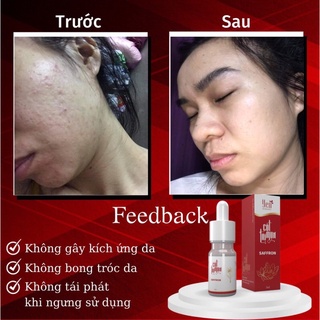 [Sỉ 5 lọ] Serum Cốt Sạch Mụn Saffron - Sẵn Hàng