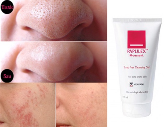 Sữa rửa mặt ngăn dầu giảm mụn Papulex Moussant Cleansing 150ml