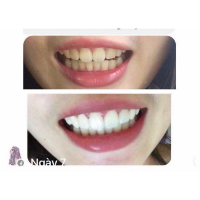 [TẶNG BÀN CHẢI ĐÁNH RĂNG BOSSI] Combo Trắng Răng Than Hoạt Tính SMILE UP