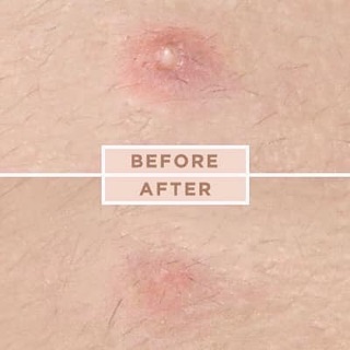 MIẾNG DÁN MỤN COSRX ACNE PIMPLE MASTER PATCH