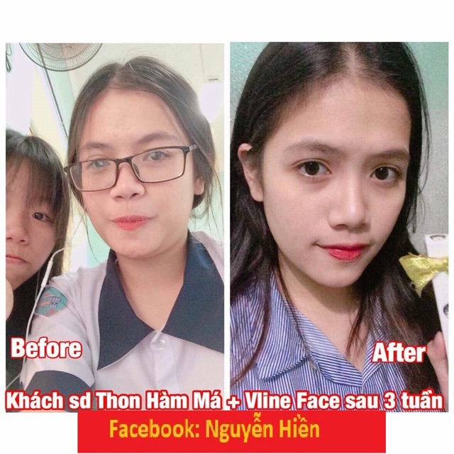 Tinh Chất Thu xương Vline Face Hàn