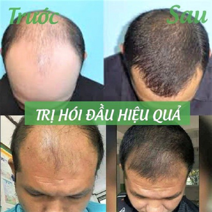 Dầu Gội Thiên Nhiên - TINH CHẤT GỘI ĐẦU THẢO MỘC MẸ KEN- Dùng được cho em bé