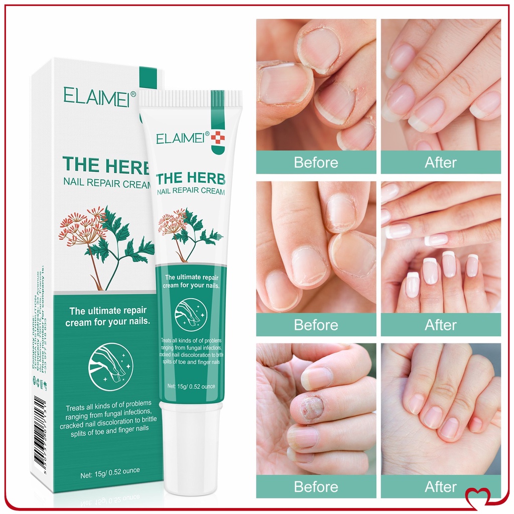 Elaimei 15G Chăm Sóc Móng Kem Kem Điều Trị Nấm Loại Bỏ Móng Paronychia Onychomycosis Lò Xông Tinh Dầu Onychomycosis Dinh Dưỡng Kem