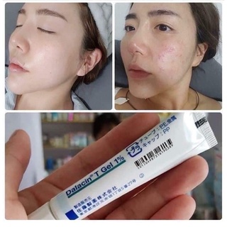 Gel bôi mụn viêm