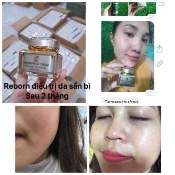 Kem Nám,Tàn Nhang,Đốm Nâu Reborn-Kem Đêm