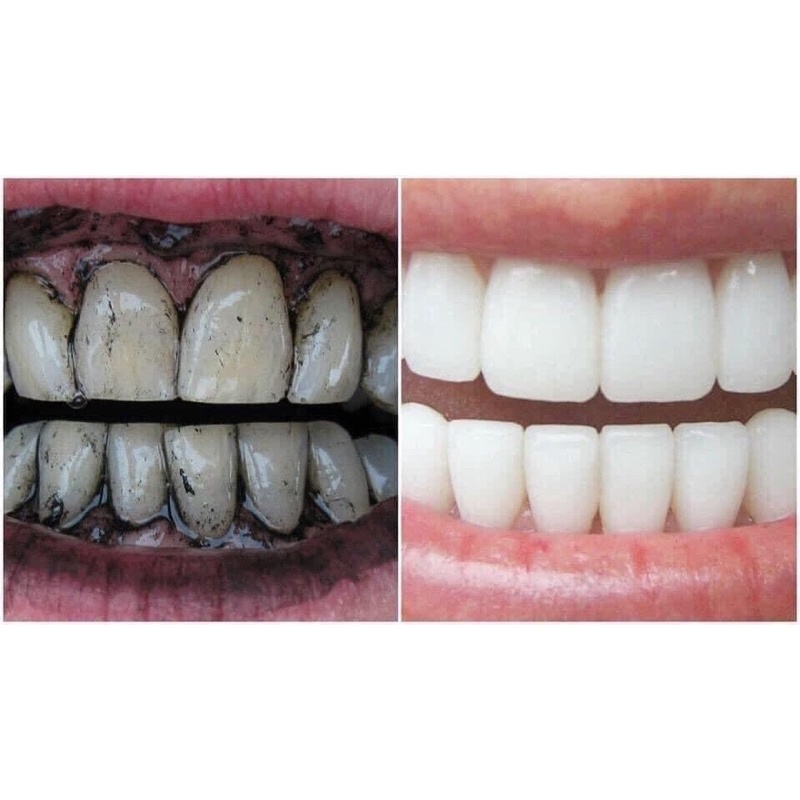 Bột than hoạt tính làm trắng răng