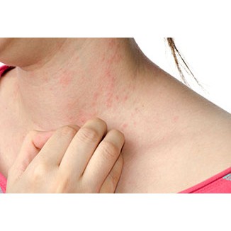 Phụ Bì Khang - Hỗ trợ điều trị mề đay, mẩm đỏ từng đám (Hộp 30 viên)