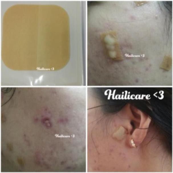 SP 1 Miếng Dán Nhanh Xẹp Mụn DuoDerm Extra Thin (date 2024) | BigBuy360 - bigbuy360.vn