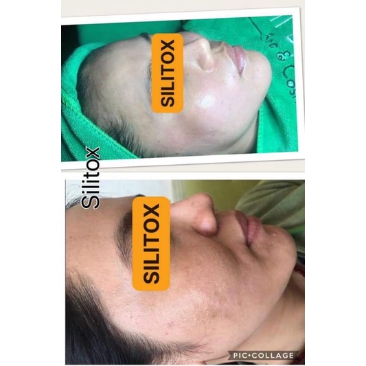 Combo vi kim sinh học Silitox 200% chăm sóc da tại nhà - Da nhăn, trùng nhão, chảy xệ Da mụn bít tắc thâm sau mụn