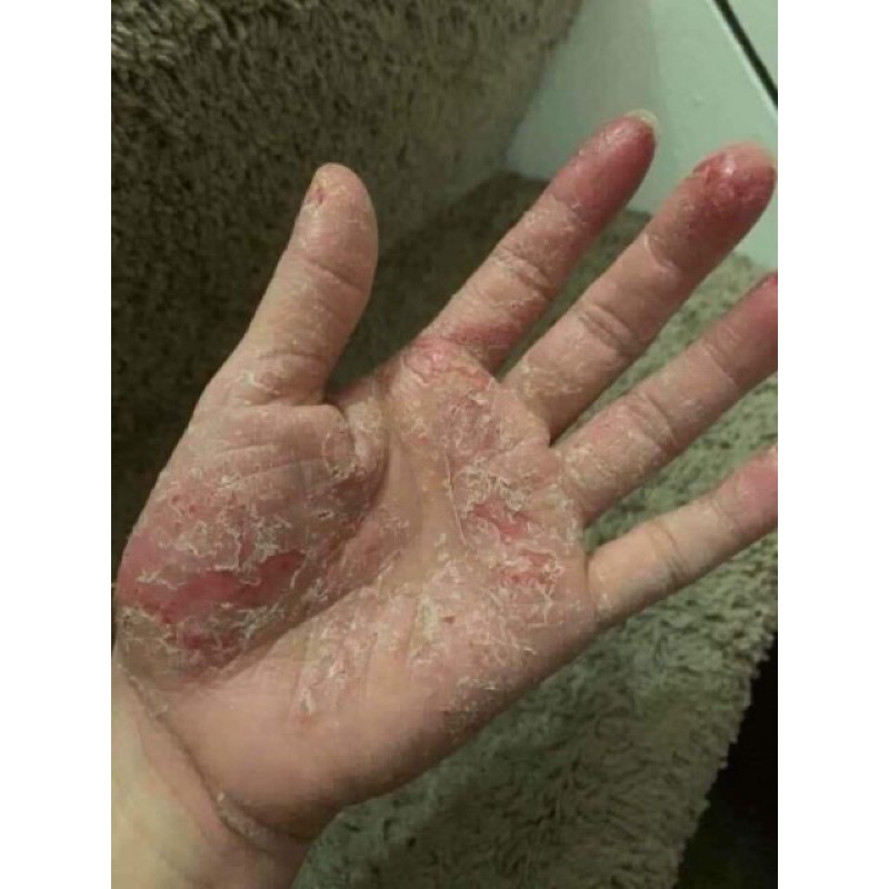 |Hộp Đỏ| Kem bôi da bệnh Vẩy nến, Nấm ngứa, á sừng, Hắc lào. |PKTrungBinh