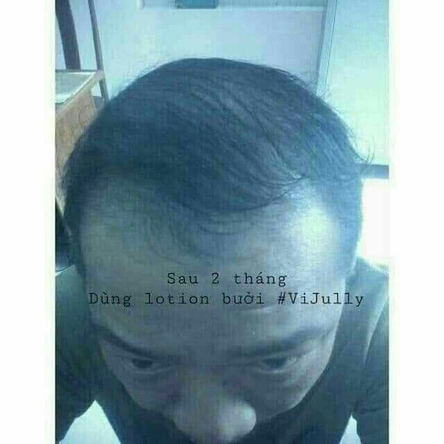 ( Tặng Ví Từ 2 Chai ) Tinh Dầu Bưởi Cao Cấp Vi Jully  - Trị Rụng Tóc Kích Thích Mọc Tóc Làm Dài Tóc | BigBuy360 - bigbuy360.vn