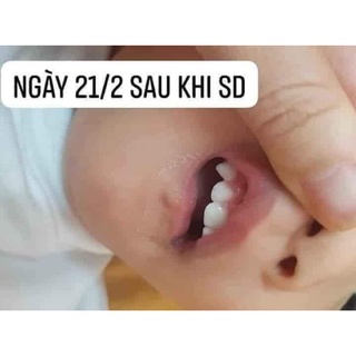 que bôi chống sâu răng vecni flour mỹ