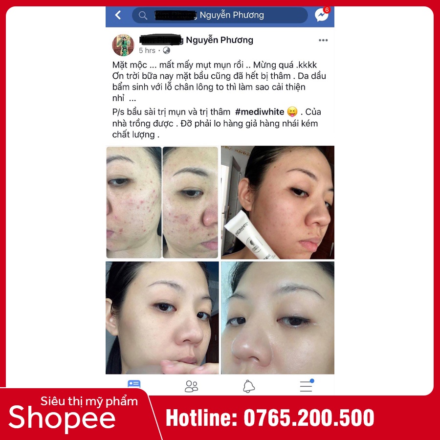 Kem Mụn Medi White - Medi Acne - Ngừa Mụn, Hết Thâm Hiệu Quả | BigBuy360 - bigbuy360.vn