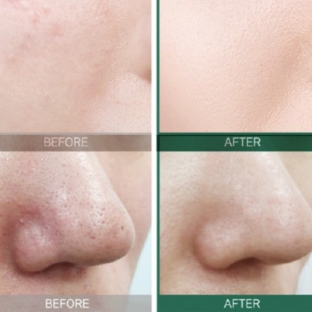 Nước Hoa Hồng Some By Mi AHA-BHA-PHA 30 Days Miracle Toner 150ml Giúp làm sạch bụi bẩn, bã nhờn và da chết trên bề mặt d | BigBuy360 - bigbuy360.vn