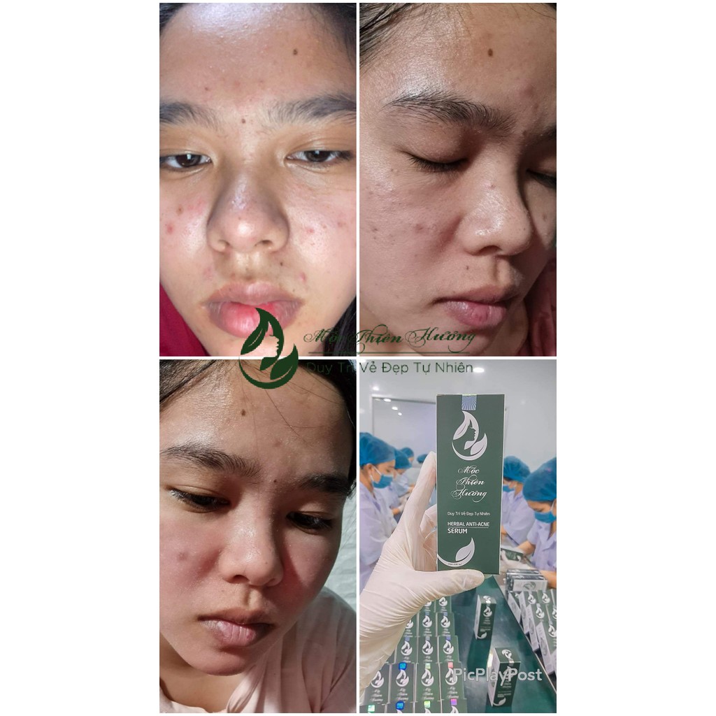 Serum Hết Mụn Ngừa Thâm Nám Mộc Thiên Hương 50ml | BigBuy360 - bigbuy360.vn