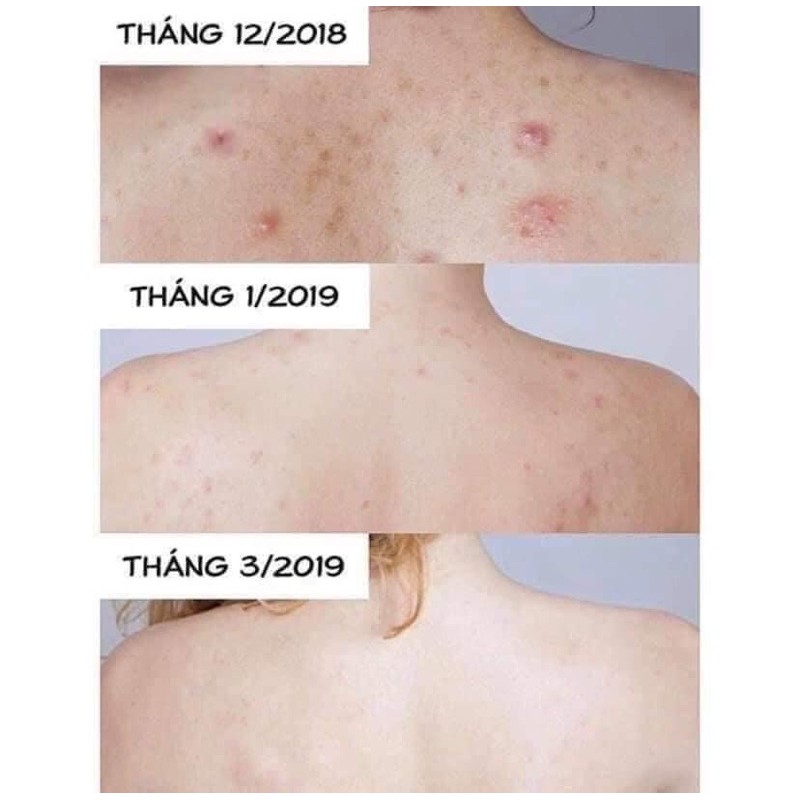 Xà phòng mụn lưng Forback Nhật