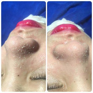 Ủ Mụn Youngerc