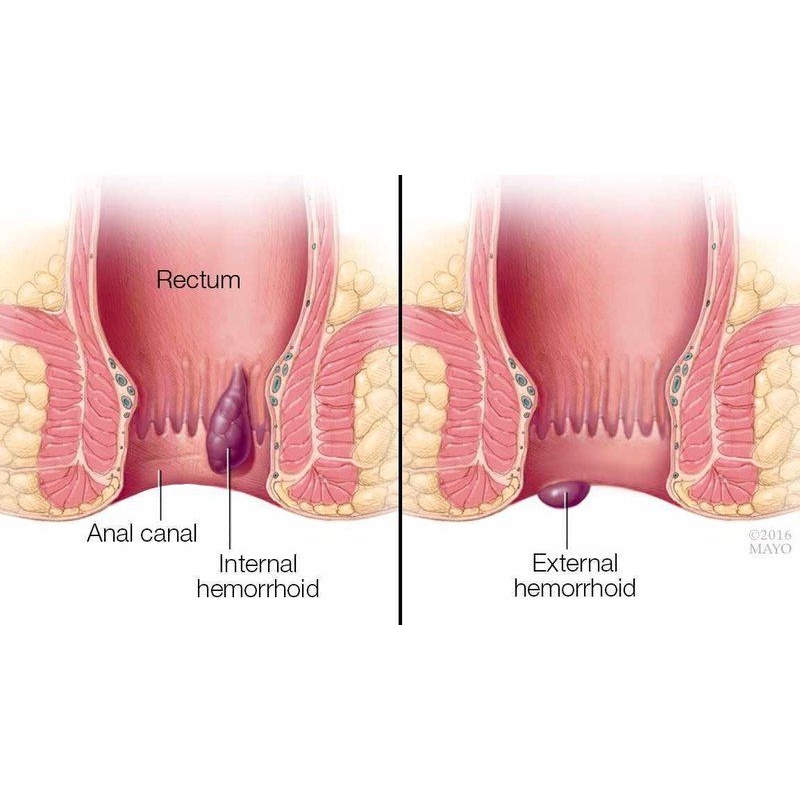 Viên đặt trĩ Hemopran giúp bảo vệ và giảm kích ứng da khu vực hậu môn 14 viên