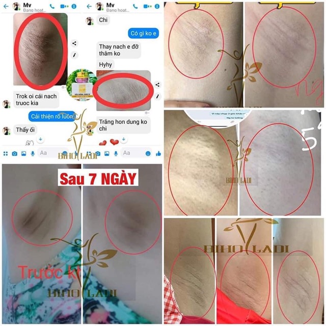 [Mua 1 tặng 1] Siêu Dưỡng thâm 5S BIHO LADI | BigBuy360 - bigbuy360.vn