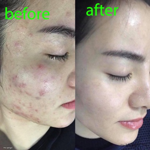 Chấm mụn giảm thâm chính hãng Puressentiel từ Pháp 10ml, giảm mụn viêm, mụn bọc