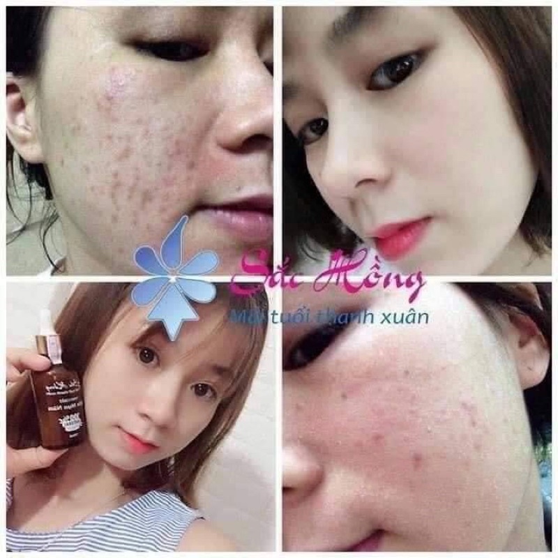 TINH CHẤT NGỪA MỤN NÁM SẮC HỒNG tái tạo làn da