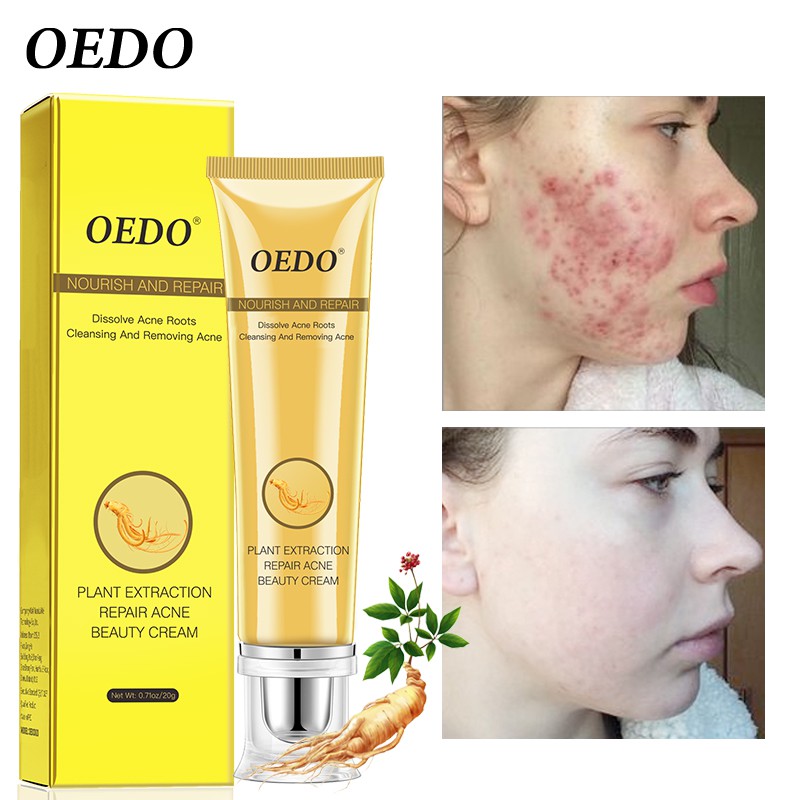 Kem Hỗ Trợ Giảm Mụn OEDO Kiềm Dầu Thu Nhỏ Lỗ Chân Lông Ngăn Ngừa Mụn 20g | BigBuy360 - bigbuy360.vn