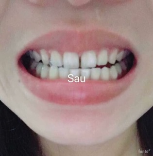 ❌ BỘT TRẮNG RĂNG THAN TRE HOẠT TÍNH WEBIG