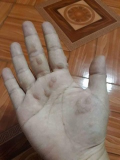 Miếng dán mụn mắt cá chân